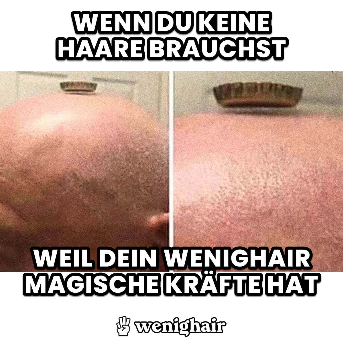 Ein Meme über Haarausfall und Glatzen mit dem Text: "Wenn du keine Haare brauchst, weil dein wenighair magische Kräfte hat" und einem schwebenden Kronkorken.