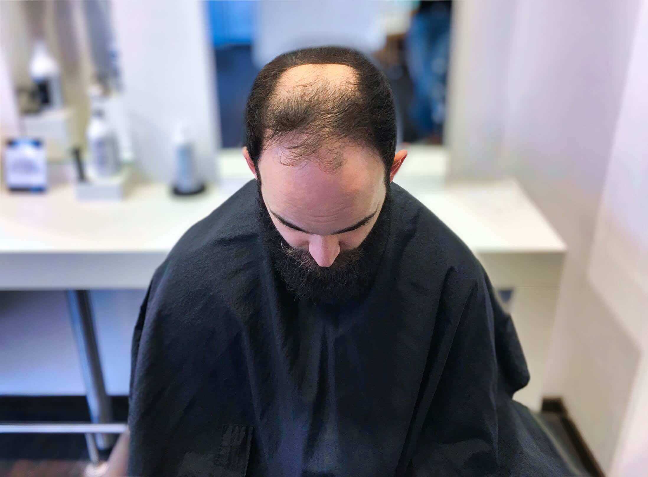 Mann mit Haarausfall und Glatze, selbstbewusst nach Friseurbesuch, Inspiration für Glatzenfrisur und Selbstakzeptanz