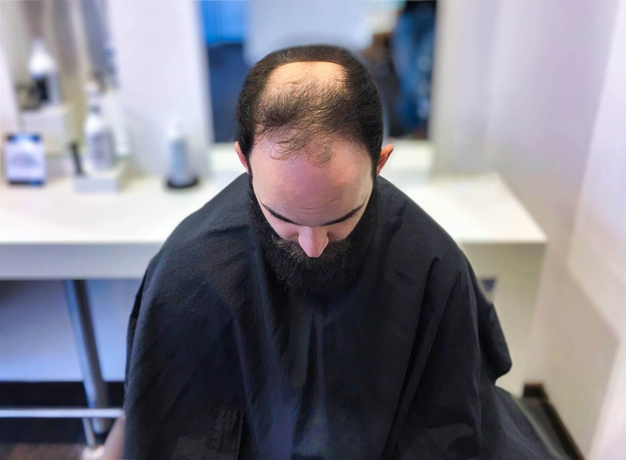 Nahaufnahme: Starker Haarausfall bei einem Mann von oben, der den Leidensdruck vor der Entscheidung fuer eine Glatze symbolisiert.