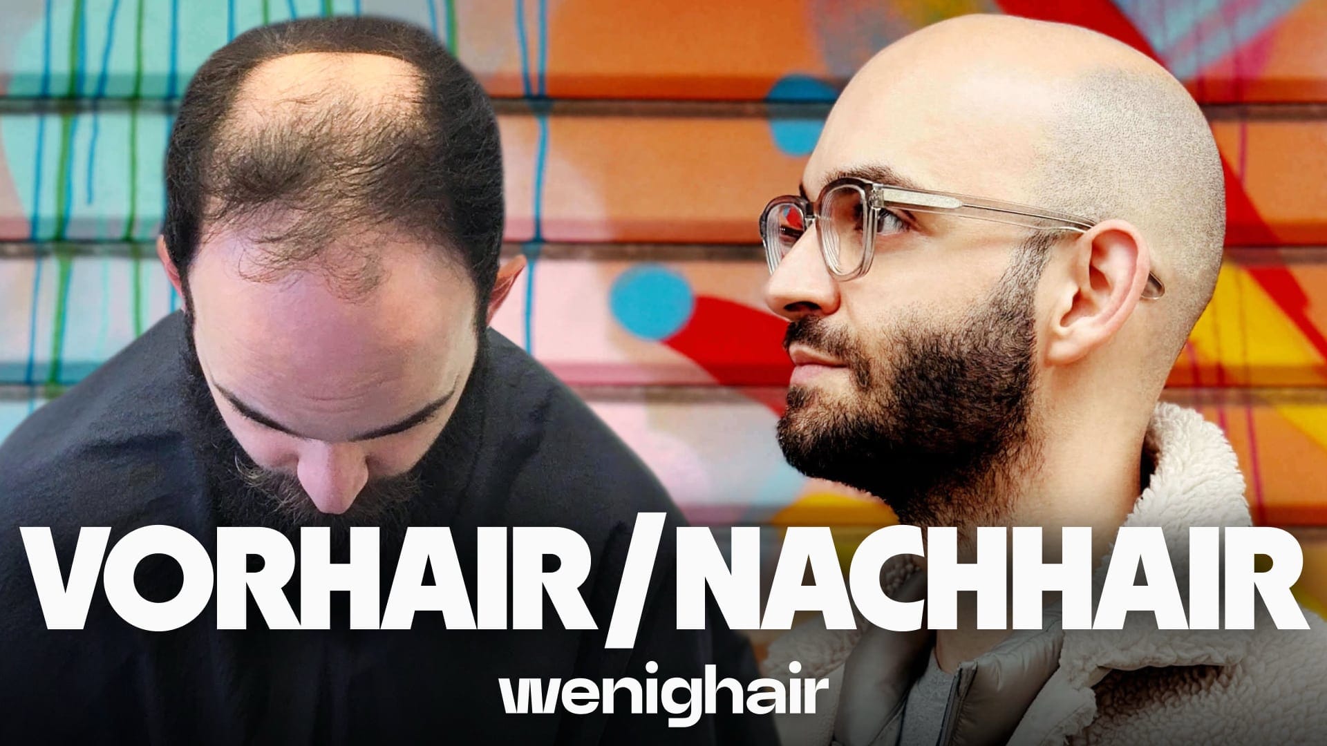 Drastische Glatze vorher nachher Transformation von Christos: Links mit schütterem Haar und Unsicherheit, rechts mit selbstbewusster wenighair-Glatze und Bart